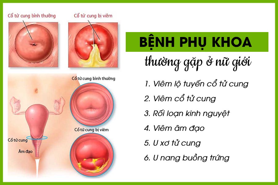 6 bệnh phụ khoa thường gặp ở nữ giới: Nguyên nhân, triệu chứng & cách phòng ngừa