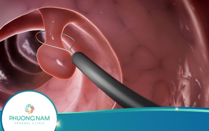 Polyp Đại Tràng Sigma – Bệnh Lý Không Thể Xem Thường