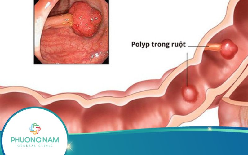 Polyp Trực Tràng – Những Thông Tin Từ A Đến Z Bạn Nên Biết