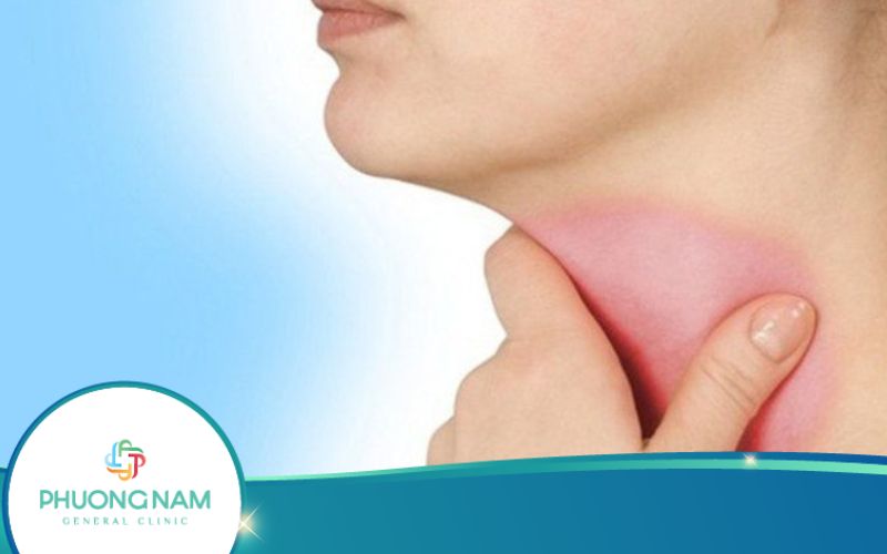Viêm Họng Mạn Tính – Nguyên Nhân, Triệu Chứng, Cách Điều Trị