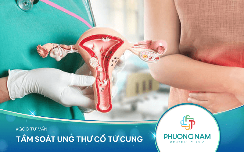 Đừng chủ quan với ung thư cổ tử cung ở nữ giới Tam-soat-ung-thu-co-tu-cung-phu-nu-nhat-dinh-phai-doc