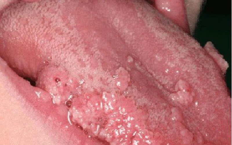 Bệnh sùi mào gà ở lưỡi là gì?