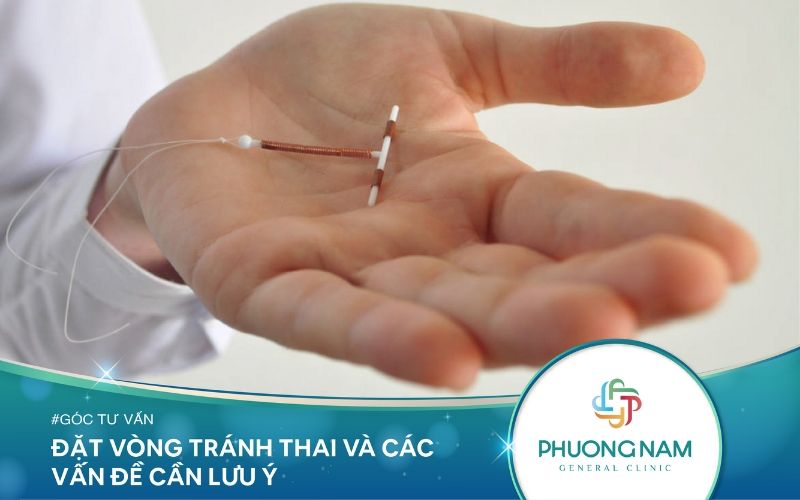 Đặt Vòng Tránh Thai Và Các Vấn Đề Cần Lưu Ý