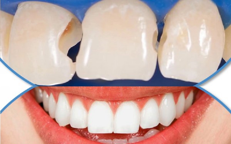 Các vật liệu hàn răng thẩm mỹ thông dụng nhất hiện nay