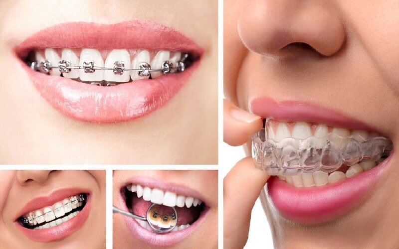 Các phương pháp niềng răng thông dụng nhất hiện nay ở Đà Lạt?