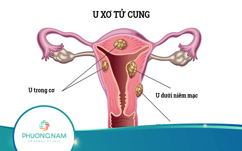 Siêu âm u xơ tử cung có phát hiên được không?