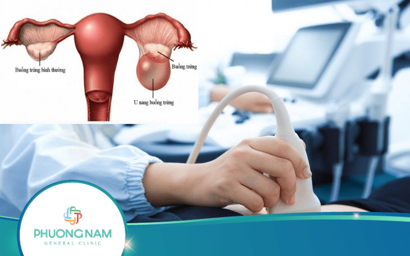Siêu Âm U Nang Buồng Trứng Để Làm Gì, Khi Nào Cần Siêu Âm