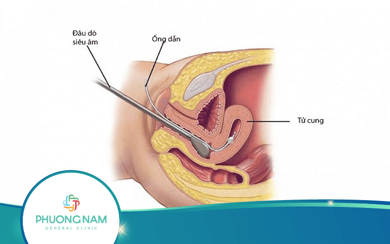 Siêu Âm Tử Cung Phát Hiện Những Bệnh Gì?