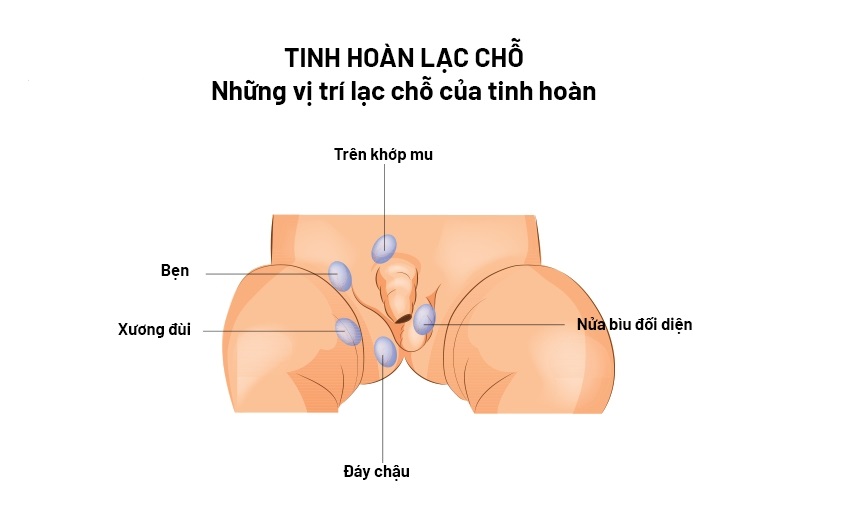 tinh hoàn lạc chỗ là tình trạng một hay cả hai tinh hoàn không di chuyển xuống bìu