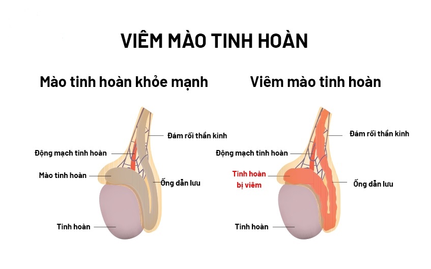 Viêm mào tinh hoàn thường gây đau nhức ở vùng bìu, có thể kèm theo sốt và các triệu chứng khác.