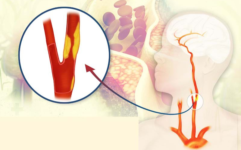 Động mạch cảnh là một nhánh lớn của động mạch chủ ngực có nhiệm vụ cung cấp máu lên não