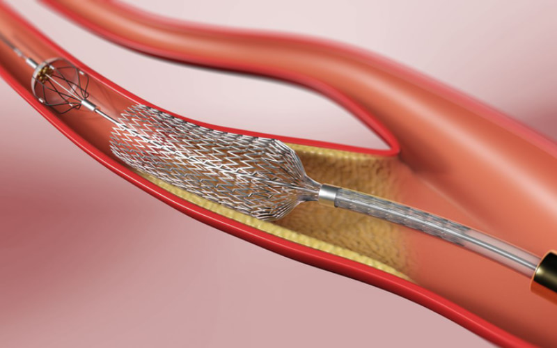 Siêu âm động mạch cảnh được thực hiện trước khi phẫu thuật đặt stent động mạch cảnh.