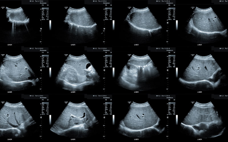 Siêu âm gan giúp bác sĩ đánh giá kích thước, hình dạng của gan, cũng như các cấu trúc bên trong. 