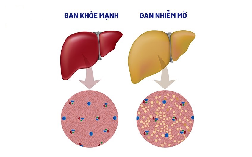 Gan nhiễm mỡ ở những giai đoạn đầu thường không có triệu chứng