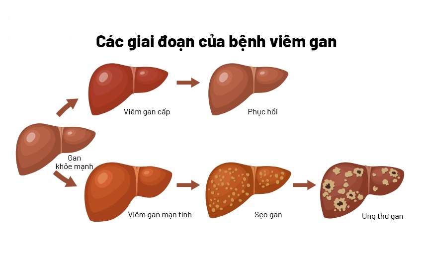 Siêu âm gan có thể phát hiện các khối u lành tính hay ác tính ở gan có kích thước nhỏ hơn 1cm