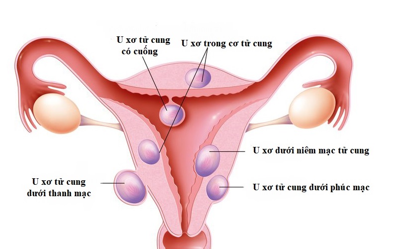 Biểu hiện của bệnh u xơ tử cung