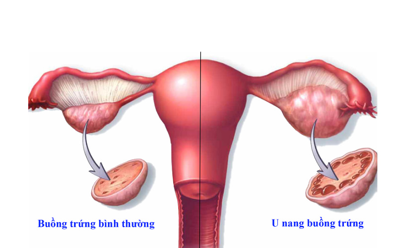 U nang buồng trứng thường gặp trong độ tuổi sinh sản. 