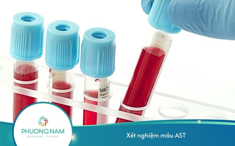 Xét Nghiệm Máu Ast (Got) Và Ý Nghĩa Trong Chẩn Đoán Bệnh