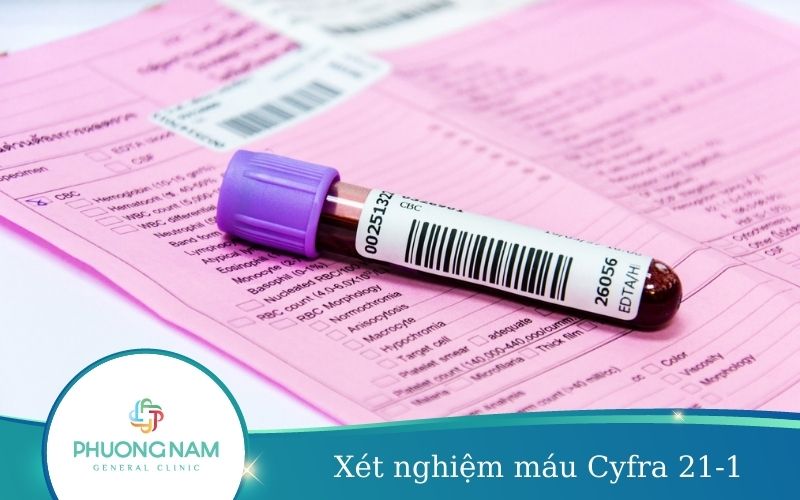 Xét Nghiệm Máu Cyfra 21-1 – Chẩn Đoán Ung Thư Phổi Hiệu Quả
