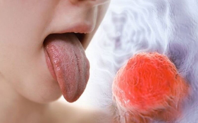 Ung thư lưỡi – Bệnh về lưỡi nguy hiểm