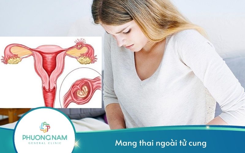 Mang Thai Ngoài Tử Cung – Cảnh Báo Nguy Hiểm Cho Mẹ Bầu