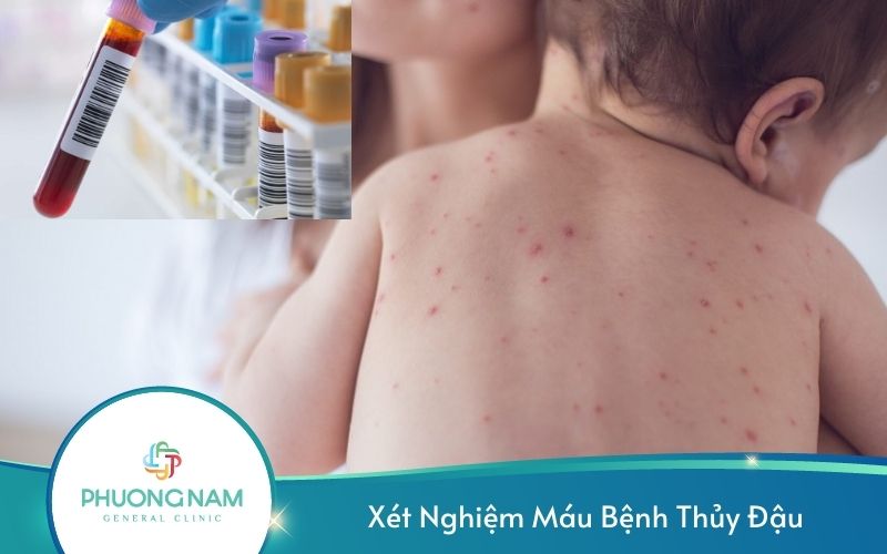 Xét Nghiệm Máu Bệnh Thủy Đậu – Những Điều Cần Biết