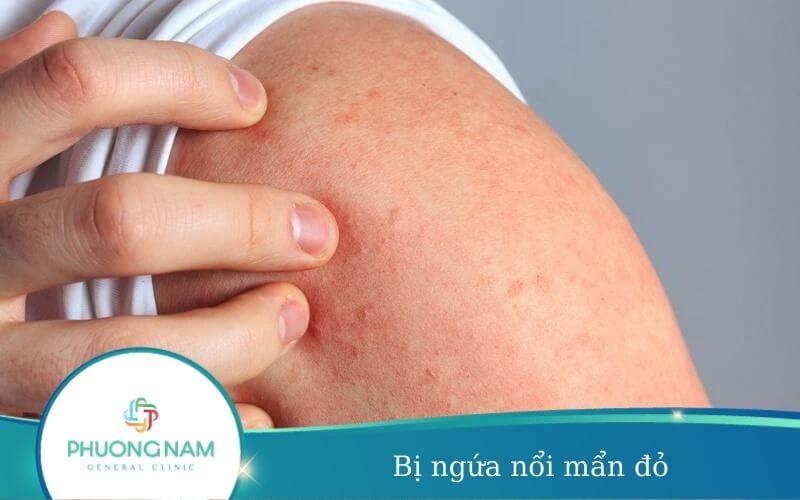 Bị Ngứa Nổi Mẩn Đỏ – Dấu Hiệu Của Nhiều Bệnh Nguy Hiểm
