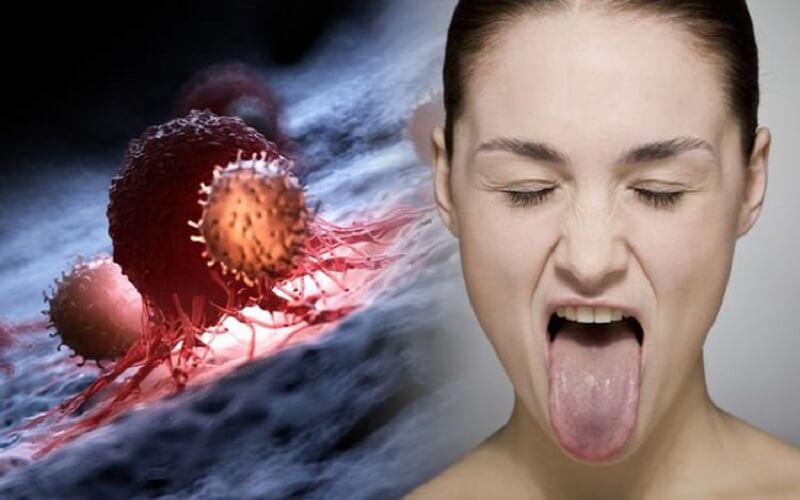 Triệu chứng nhận biết ung thư lưỡi