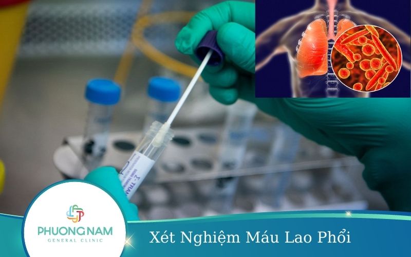Xét Nghiệm Máu Lao Phổi Được Tiến Hành Như Thế Nào?