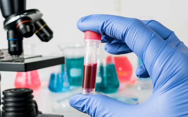 Xét nghiệm máu mcv thấp có ý nghĩa gì?
