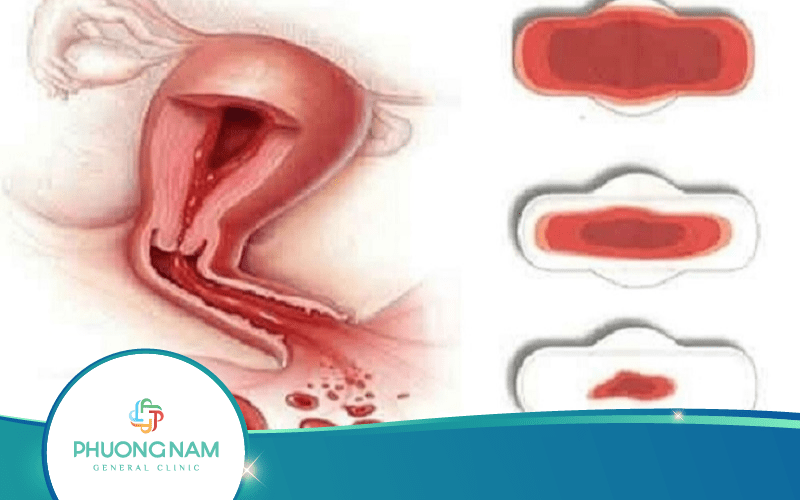 10 Mẹo Vặt Chữa Rong Kinh Tại Nhà An Toàn Và Hiệu Quả