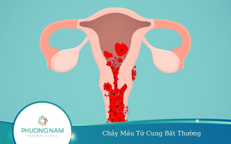 Chảy Máu Tử Cung Bất Thường – Dấu Hiệu Của Bệnh Lý Nguy Hiểm