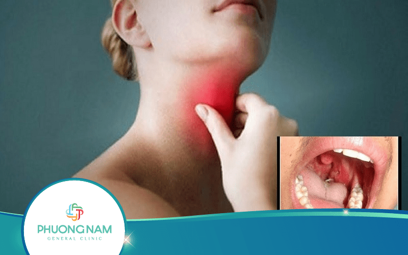 Top 8 Cách Trị Hóc Xương Cá Ở Cổ Họng Theo Dân Gian