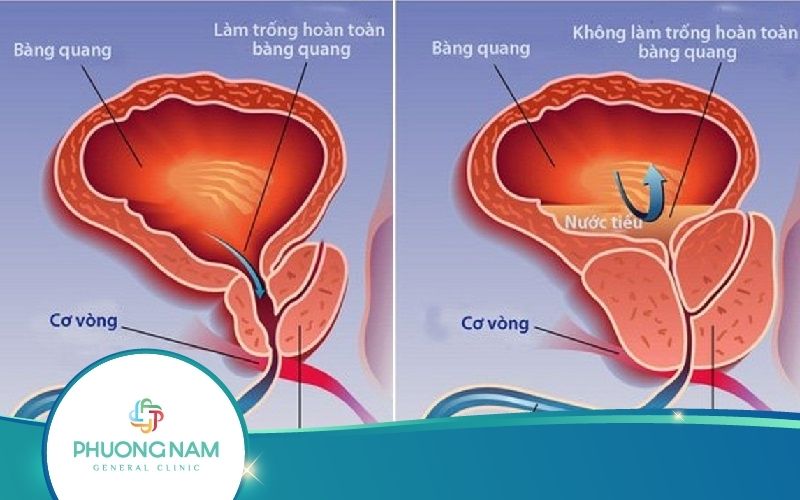 Phì Đại Tuyến Tiền Liệt – Nguyên Nhân, Triệu Chứng, Điều Trị