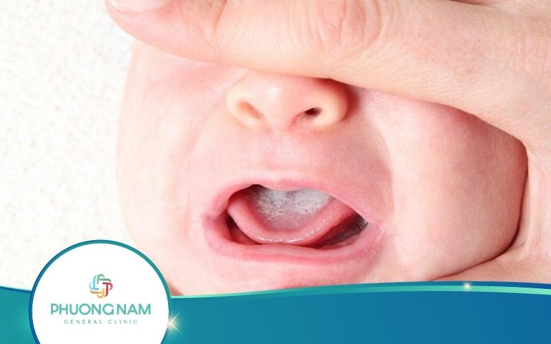Bé Bị Rộp Trắng Trong Miệng – Nguyên Nhân, Dấu Hiệu, Cách Điều Trị