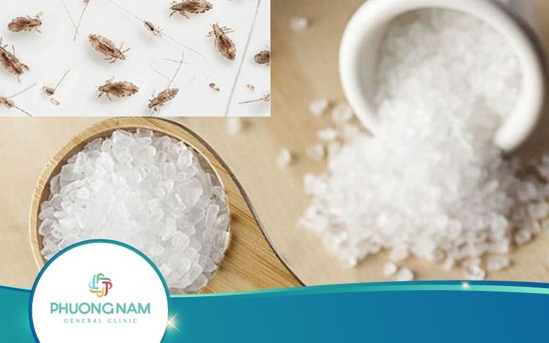 Top 3 Cách Diệt Chấy Bằng Muối An Toàn, Hiệu Quả, Nhanh Chóng
