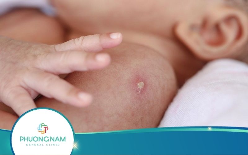 Các Phản Ứng Sau Tiêm Não Mô Cầu Bc Cần Lưu Ý