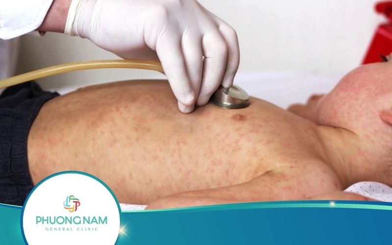 Hết Sức Lưu Ý: Tác Dụng Phụ Của Vacxin Sởi Quai Bị Rubella