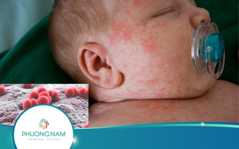 Những Điều Cần Biết Khi Tiêm Phòng Viêm Não Mô Cầu