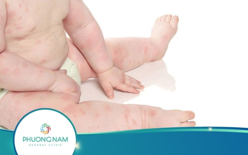 Mẹ Có Biết Trẻ Bị Mẩn Ngứa Tắm Lá Gì Nhanh Khỏi?
