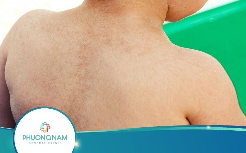 [Hỏi & Trả Lời] Trẻ Sơ Sinh Nhiều Lông Phải Làm Sao?