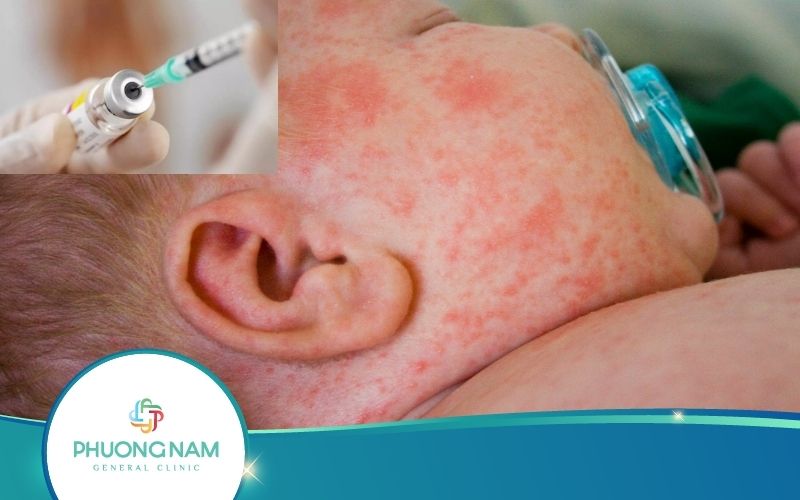 Sởi Quai Bị Rubella Có Trong Tiêm Chủng Mở Rộng Không?