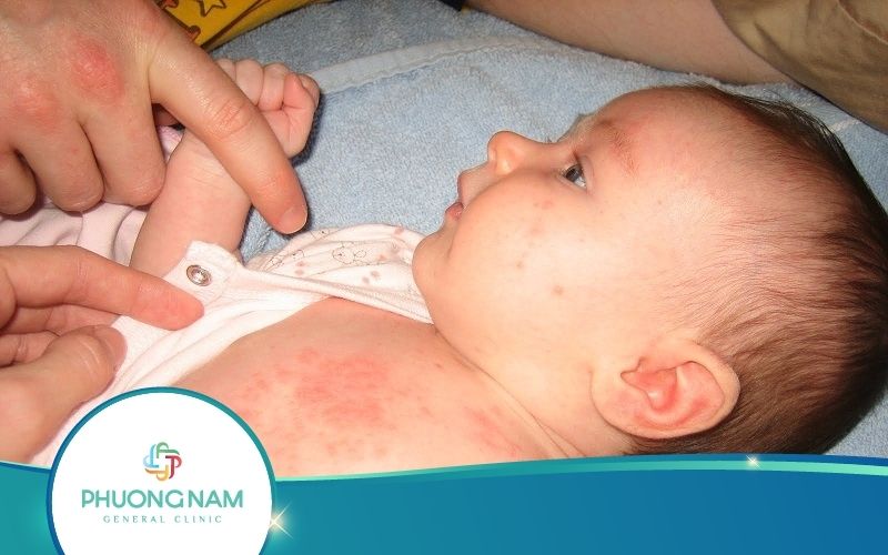 Nguyên Nhân, Triệu Chứng Và Cách Điều Trị Bệnh Sởi