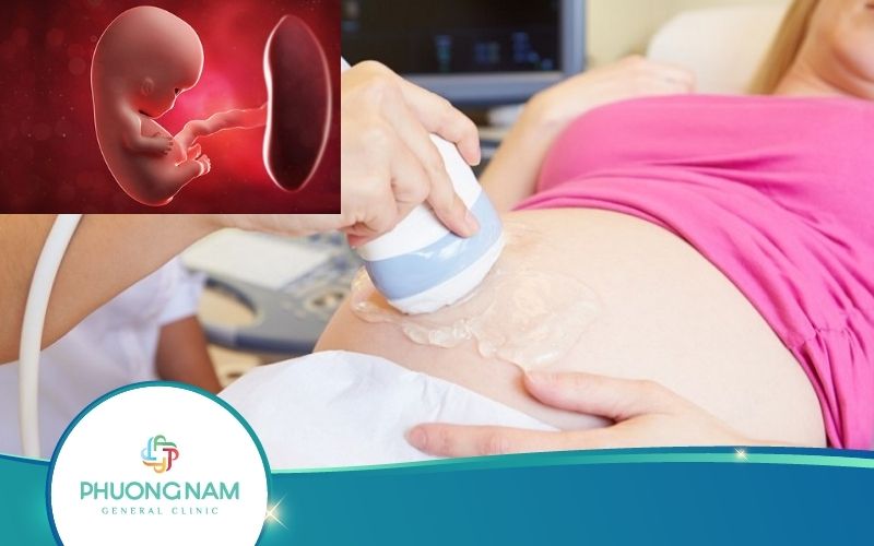 Siêu Âm Thai Có Phát Hiện Não Úng Thủy Hay Không?
