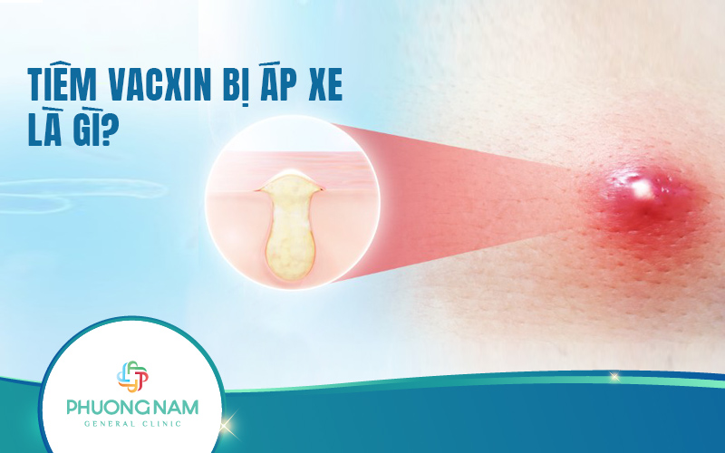 Tiêm vacxin bị áp xe: Nhận biết, triệu chứng, chữa trị và cách phòng ngưa·