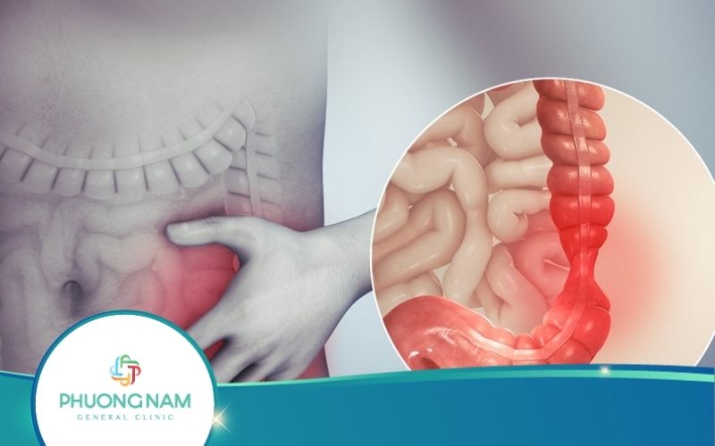 Viêm Đại Tràng: Nguyên Nhân, Triệu Chứng, Cách Điều Trị