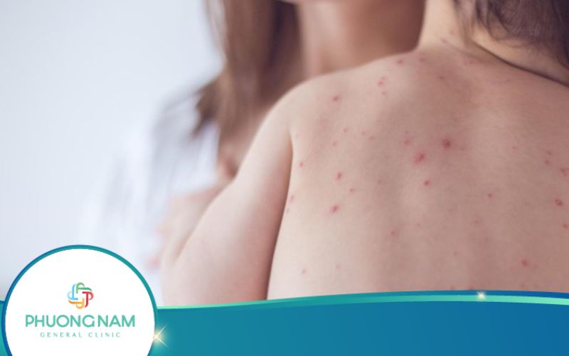 Các Bệnh Về Da Ở Trẻ Em Thường Gặp Nhất Và Cách Phòng Ngừa