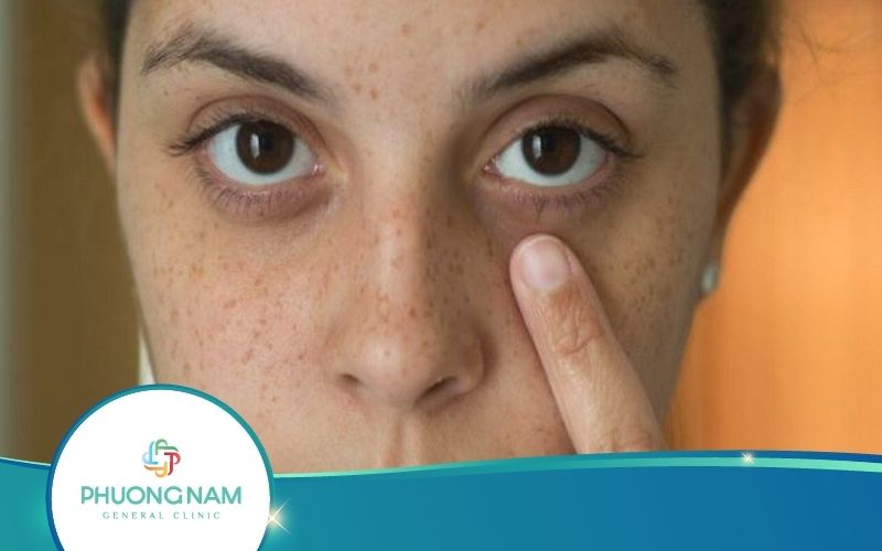 Top 15 Cách Làm Hết Thâm Quầng Mắt Sau 1 Đêm