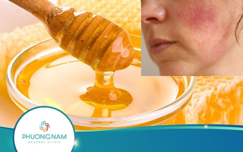 Cách Trị Dị Ứng Da Mặt Bằng Mật Ong Có Một Không Hai!