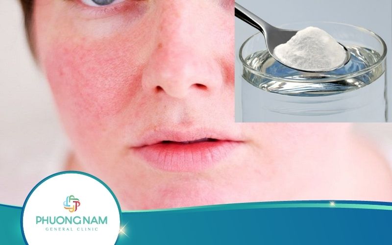 Cách Trị Dị Ứng Da Mặt Bằng Nước Muối Hay Nhất